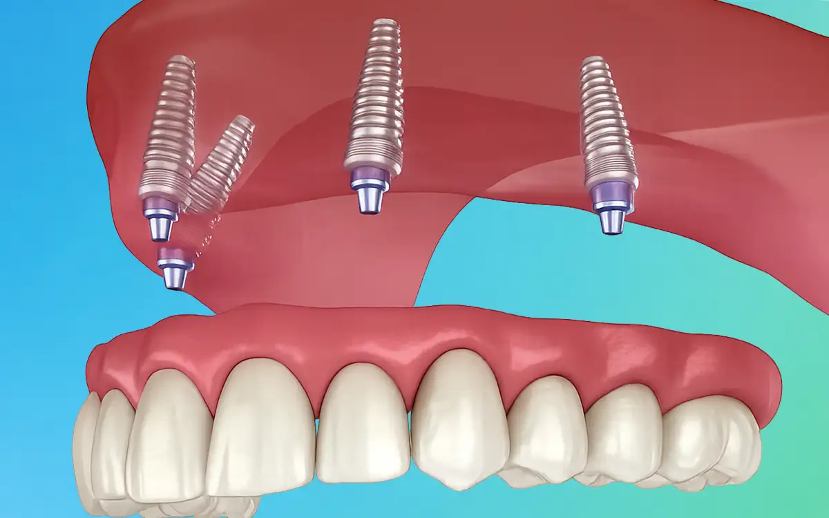 All-on-4 Dental Implants