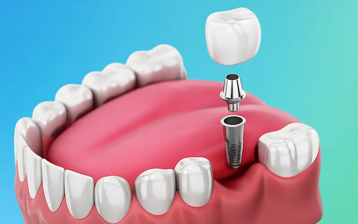 Single Tooth Implant