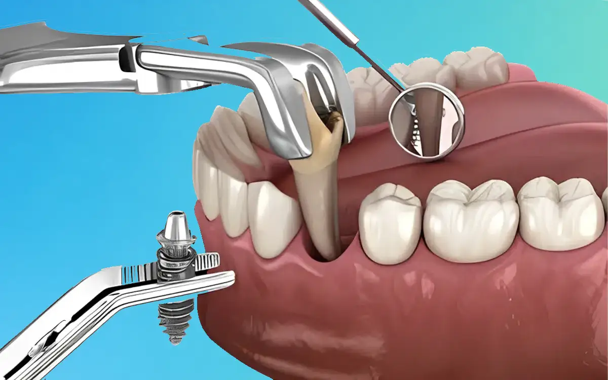 Immediate Dental Implants