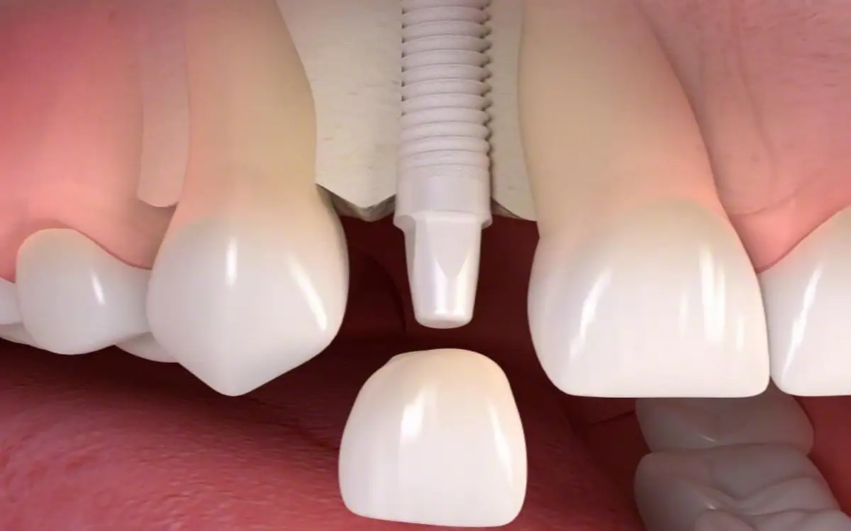 Zirconia Dental Implants