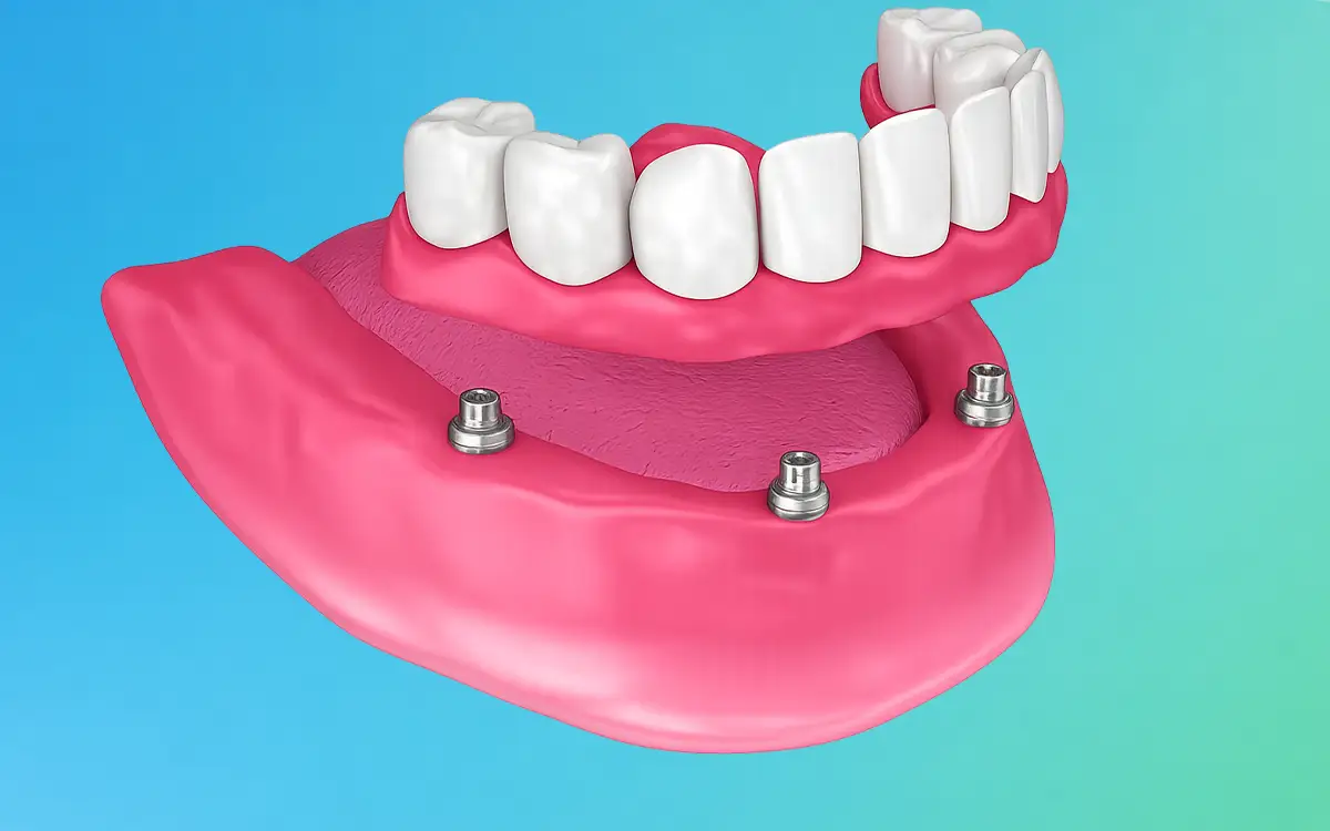 Implant-Supported Dentures
