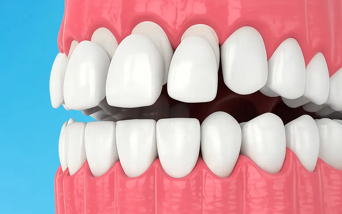 Composite Veneers