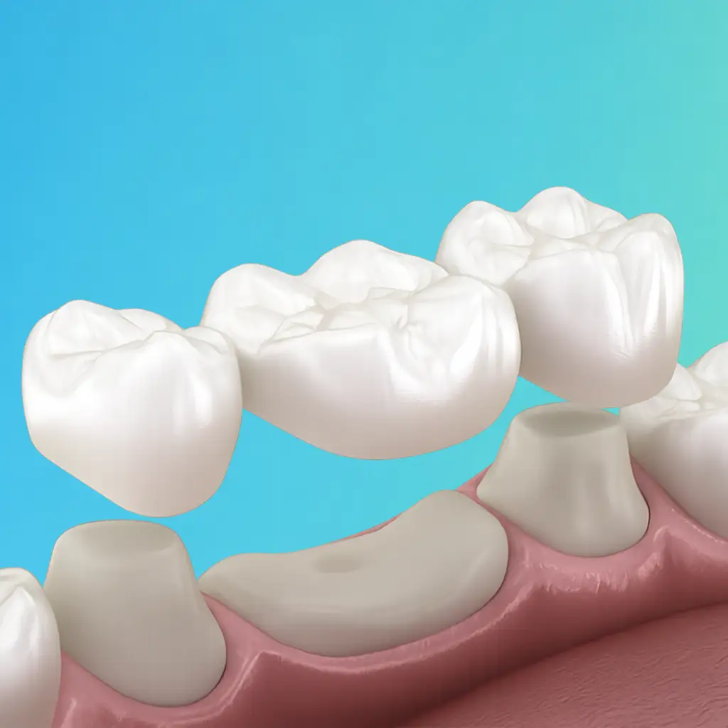How Crowns and Bridges Work