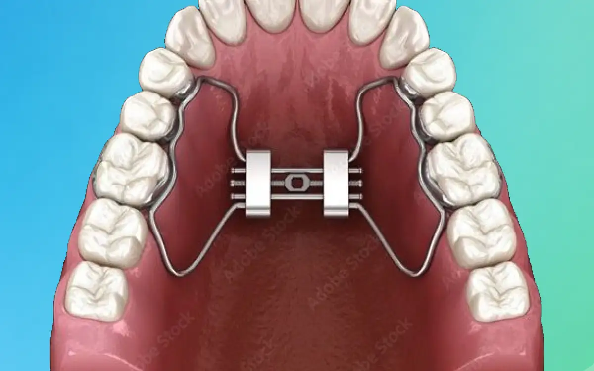Maxilla Expander