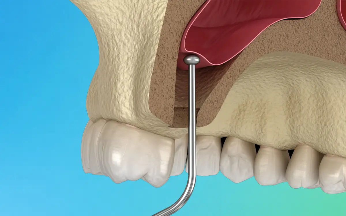 Sinus lift treatment