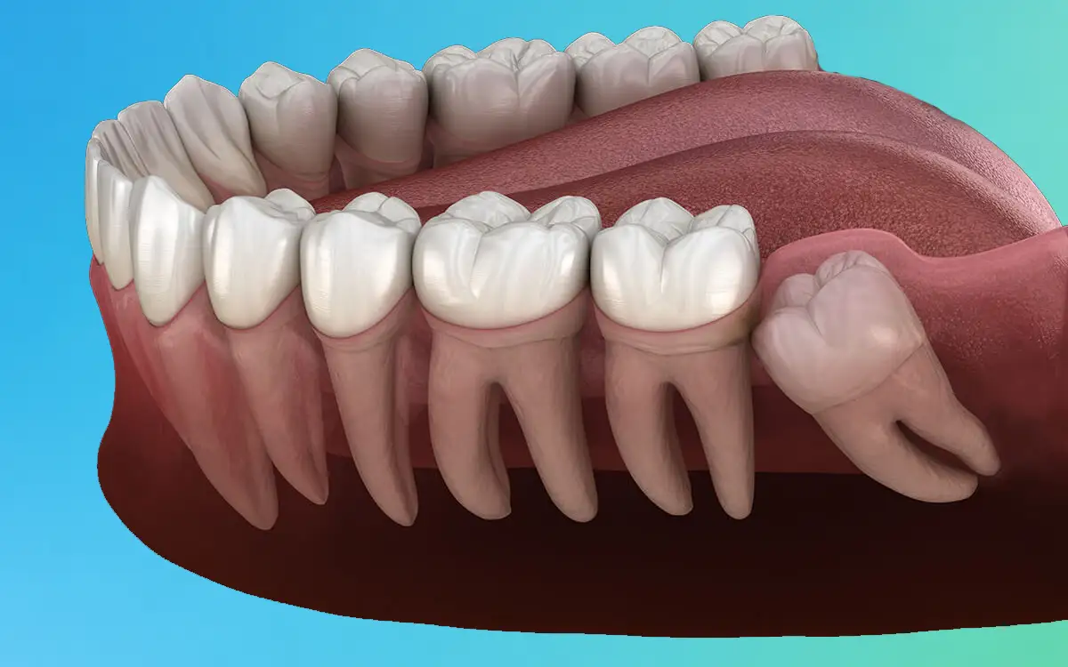 Wisdom tooth removal treatment