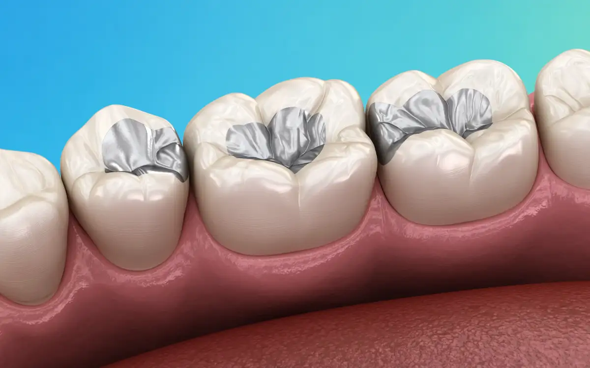 Dental fillings treatment