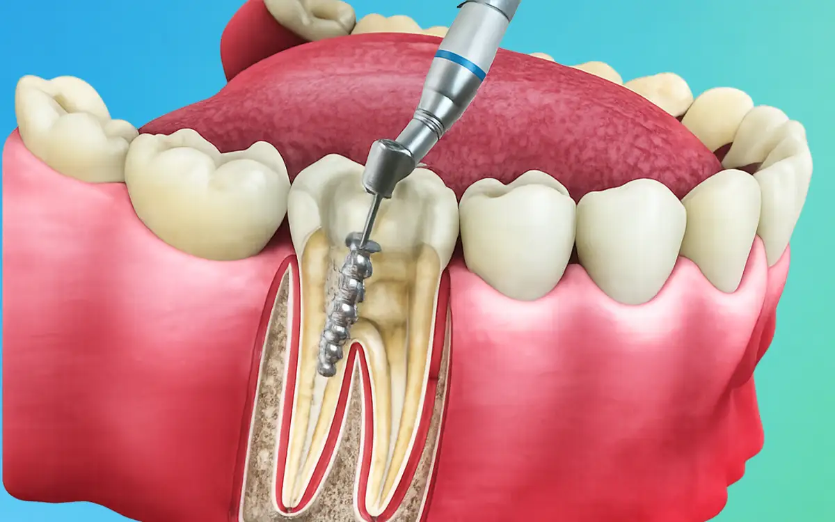 Root canal treatment