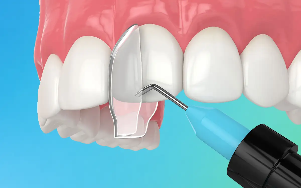 Composite bonding treatment