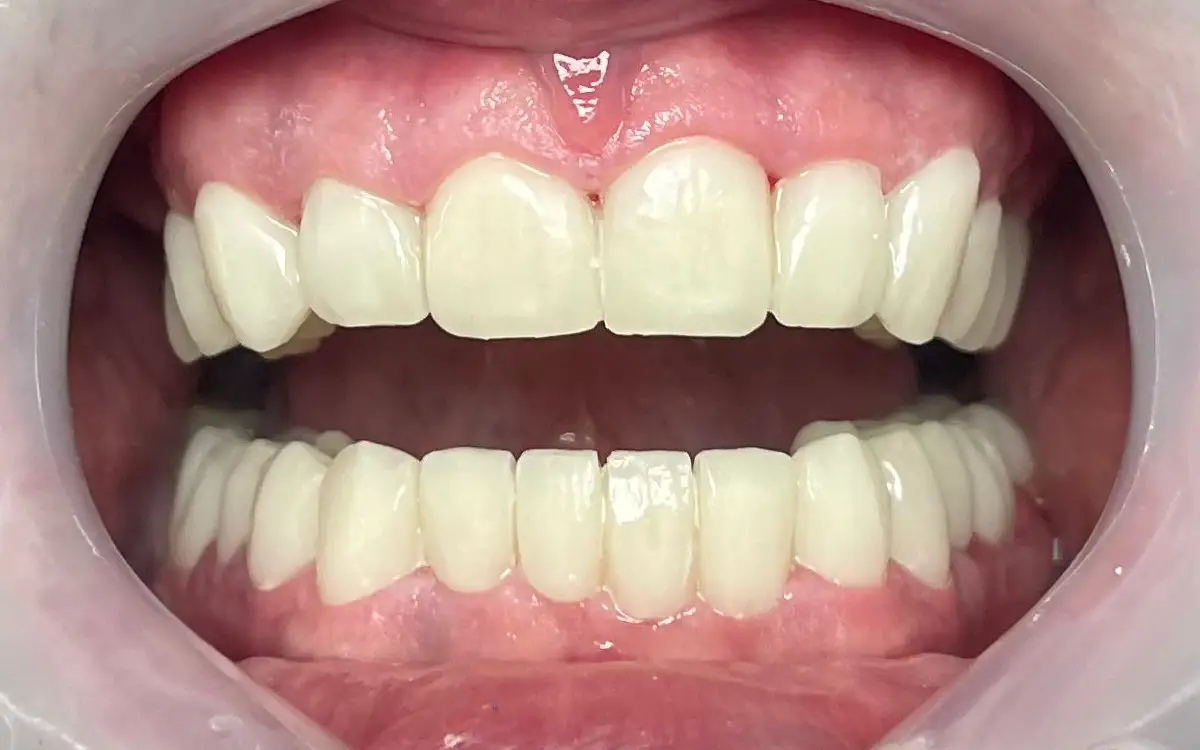 Before dental treatment 2