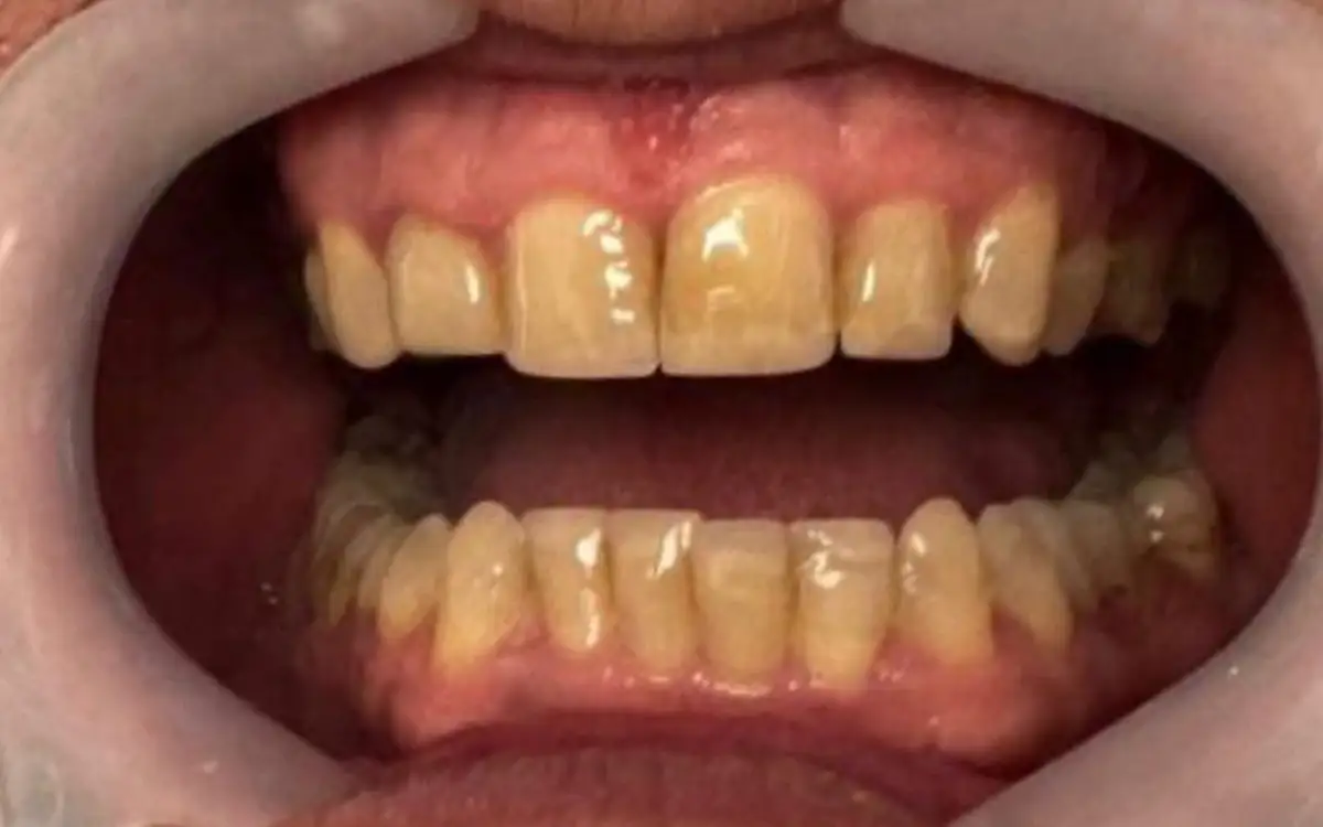 After dental treatment 2