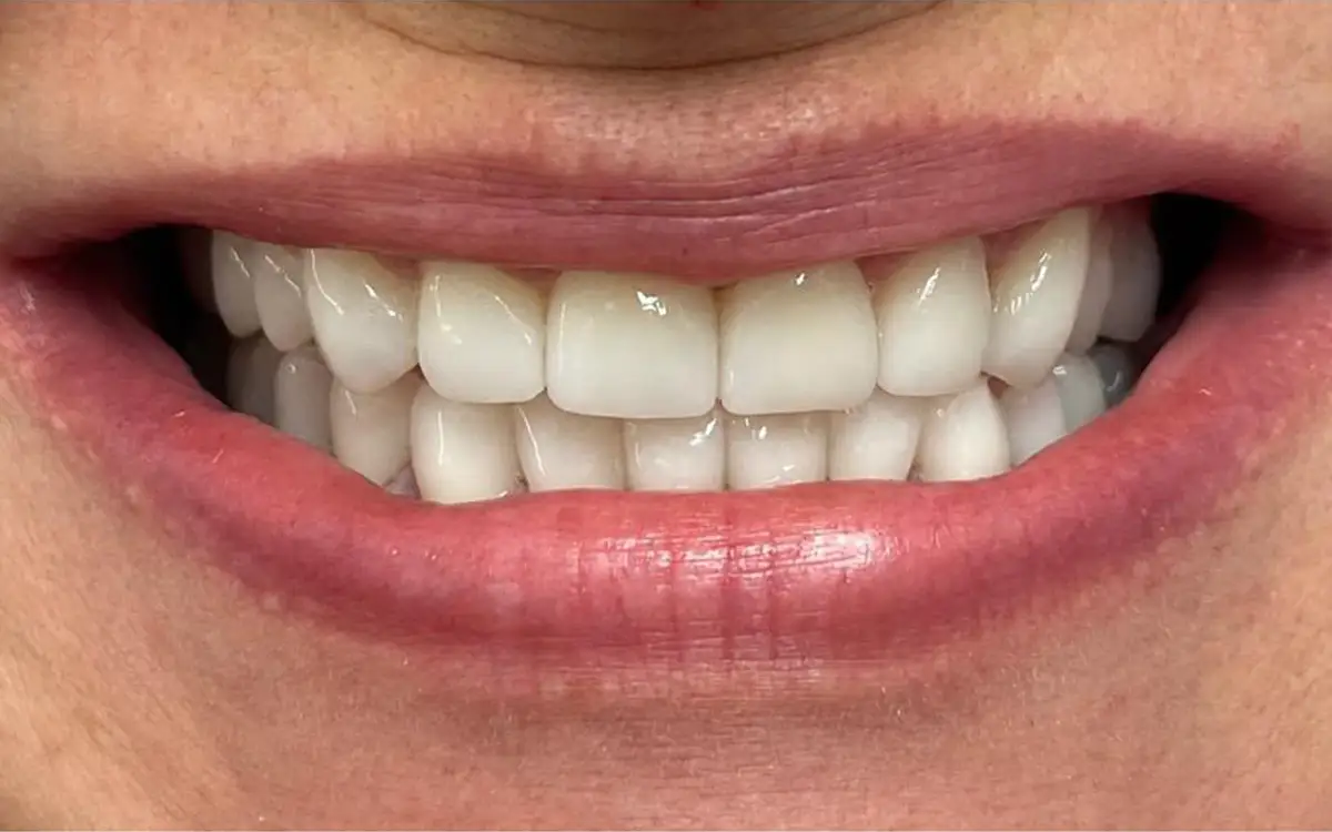 Stefania after dental treatment