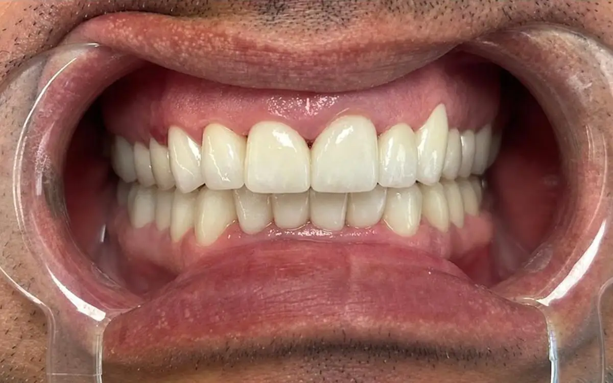 Roman after dental treatment