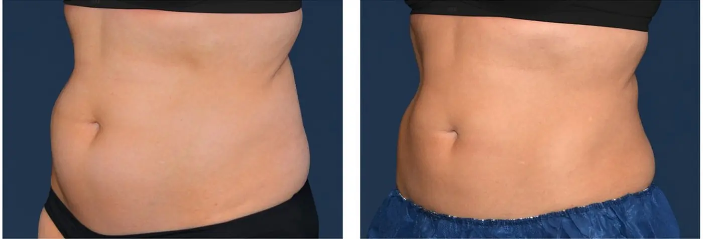 CoolSculpting abdomen and flanks before and after example