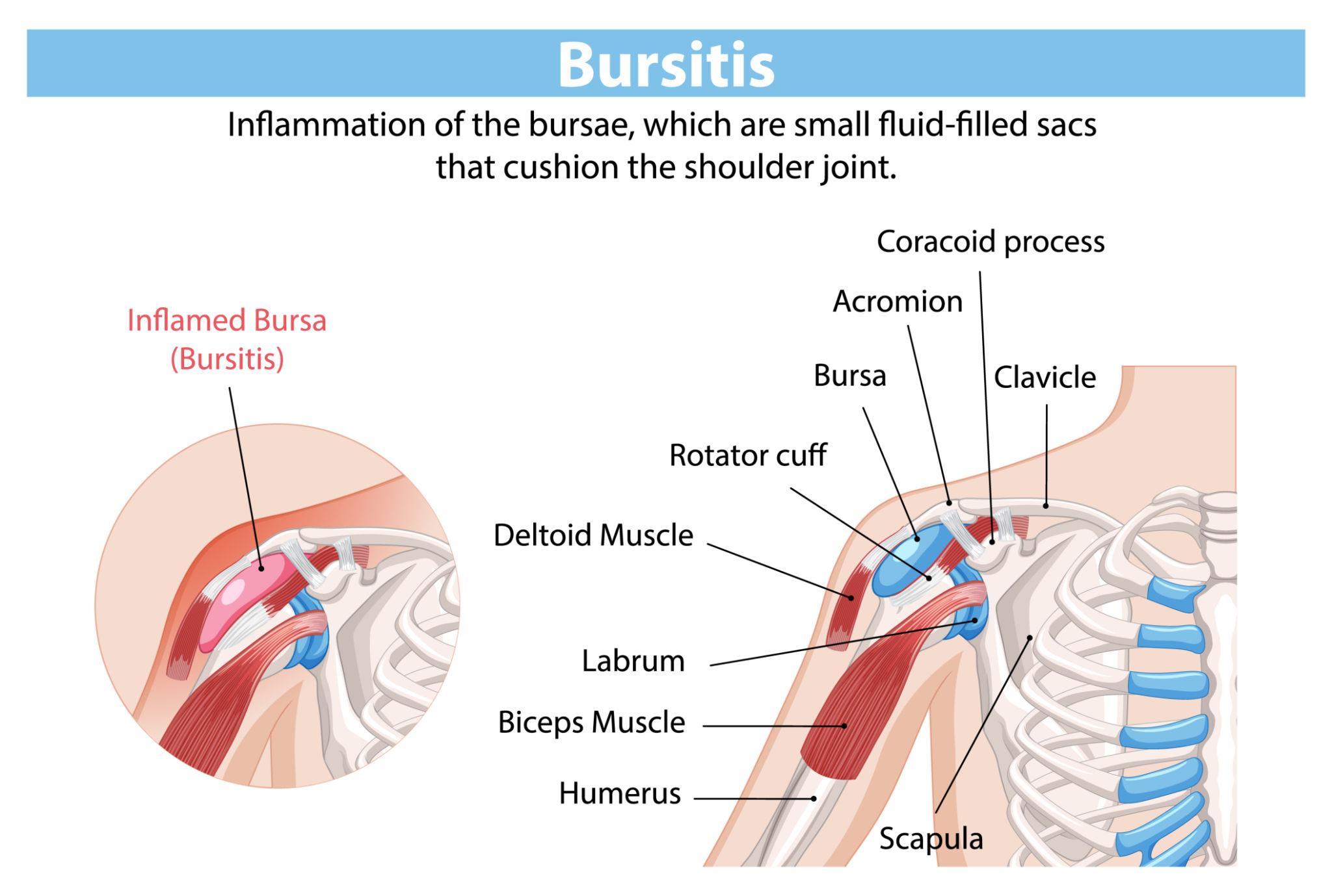 Bursitis