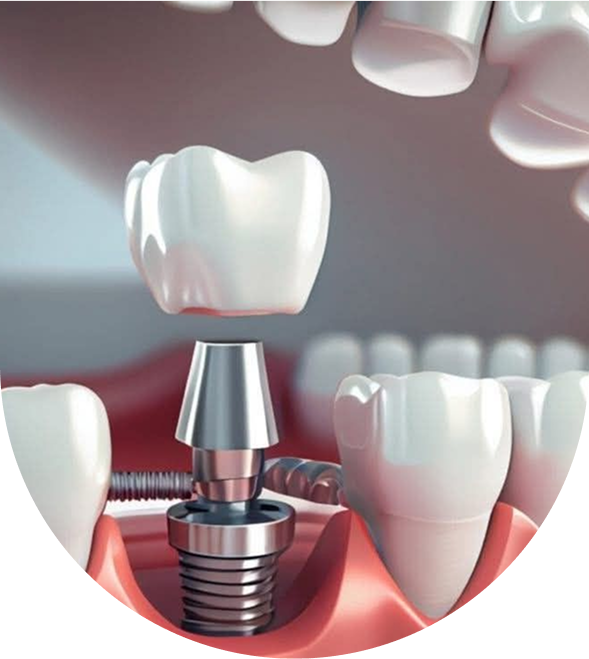 Dental Implants The Modern Solution for Missing or Damaged Teeth