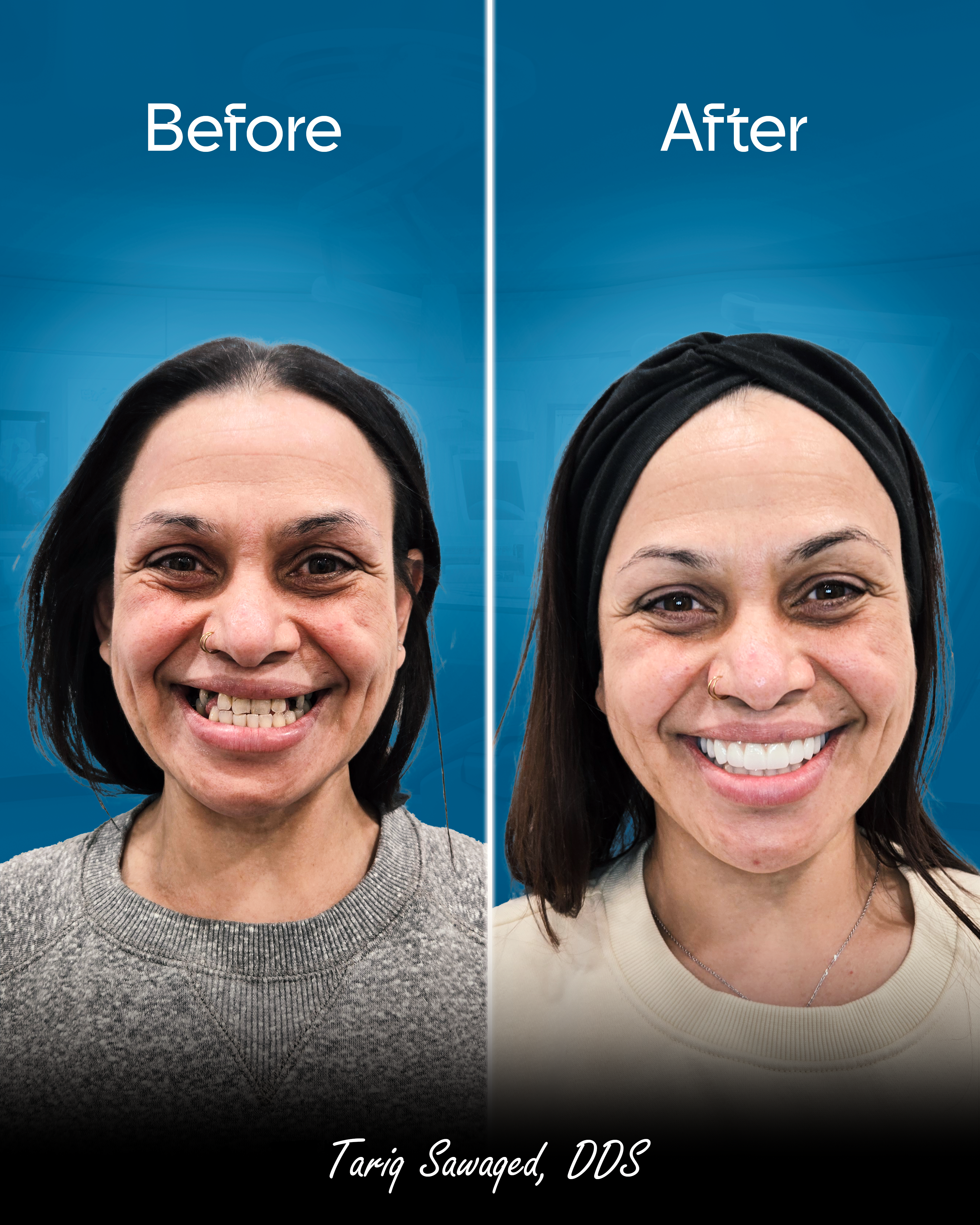 Before and after smile transformation of a woman