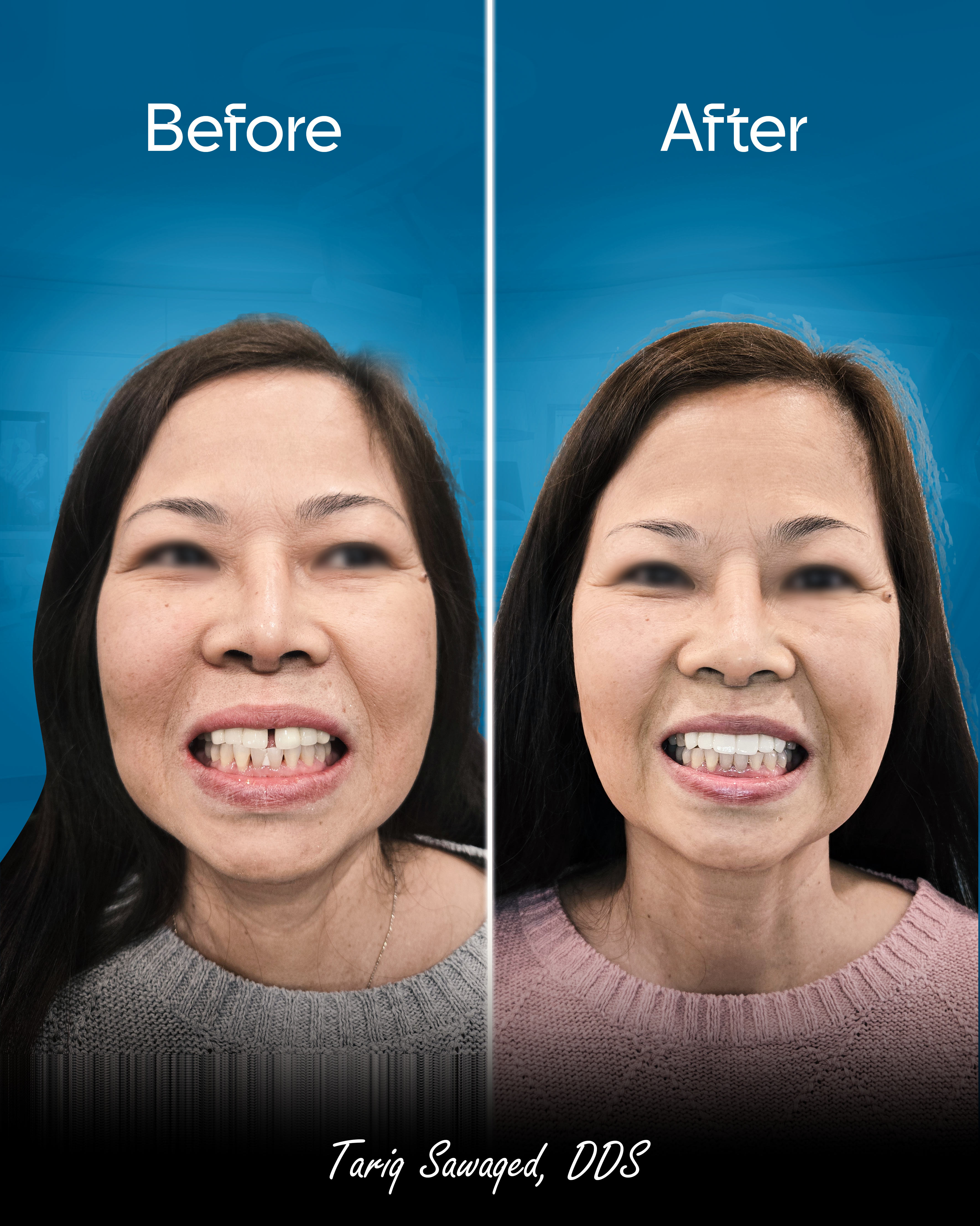 Before and after smile transformation of a woman