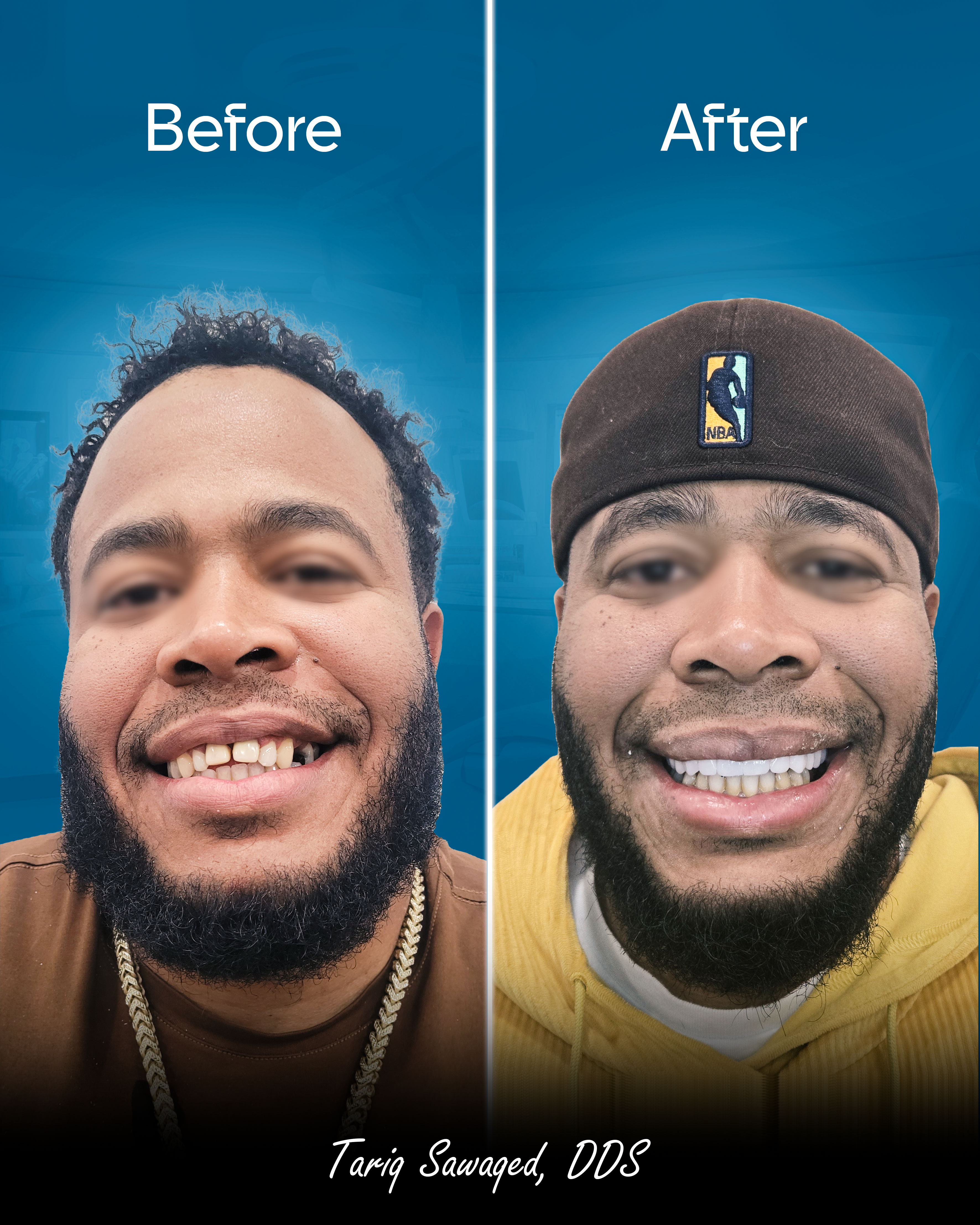 Before and after smile transformation of a man