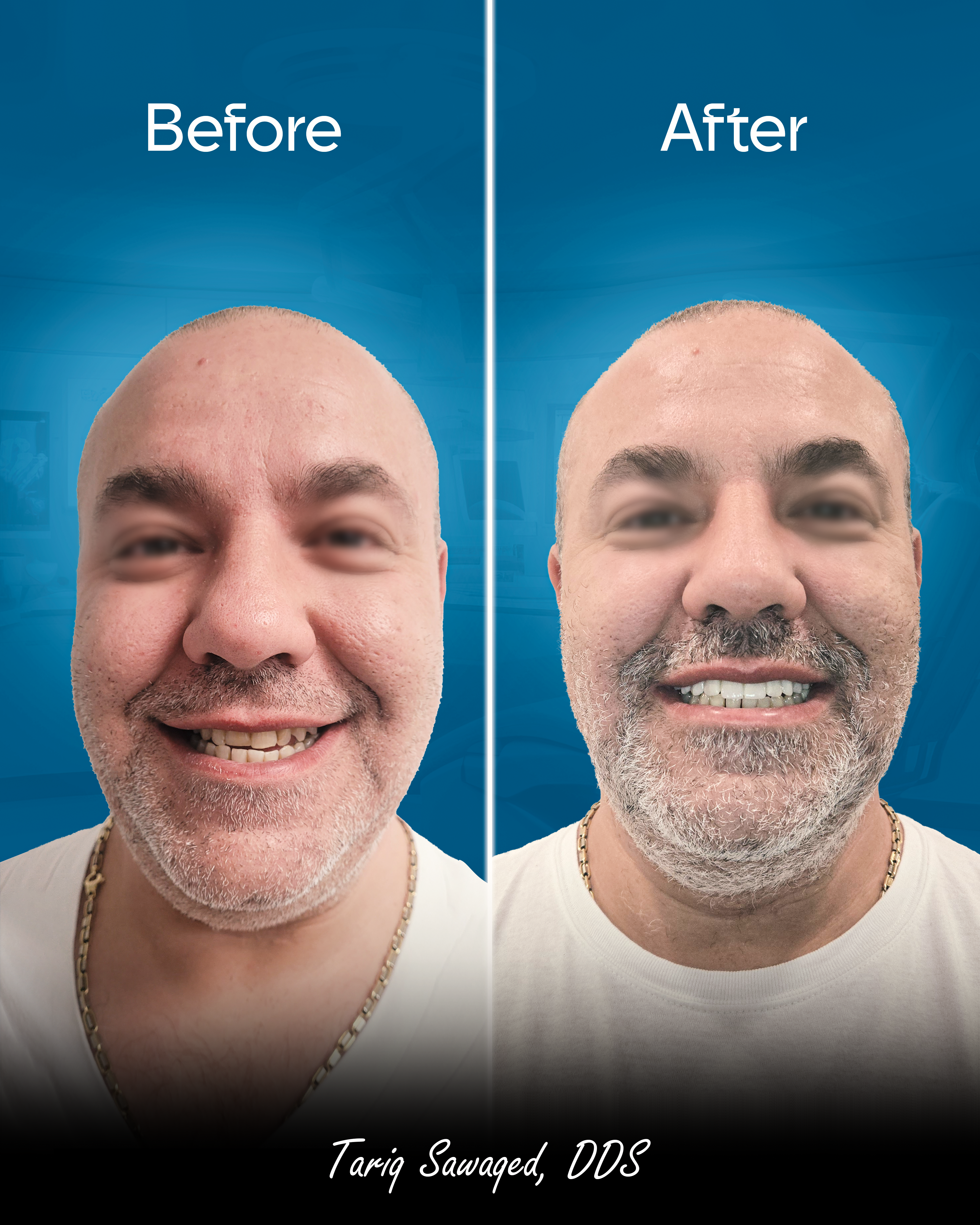 Before and after smile transformation of a man