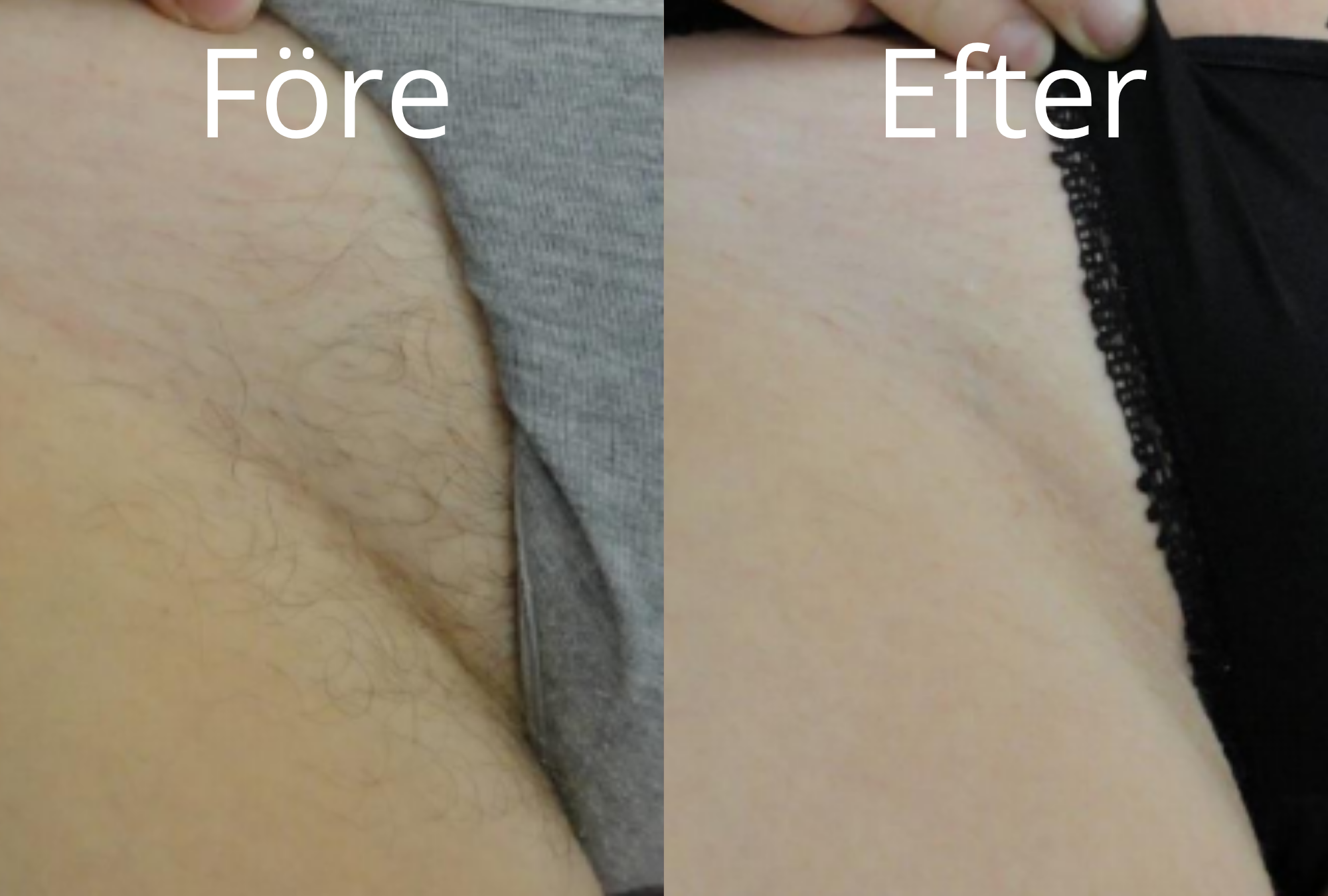 Före och efter laserhårborttagning – exempel 3
