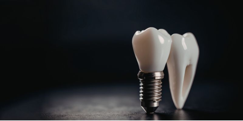 Dental implants and orthodontics