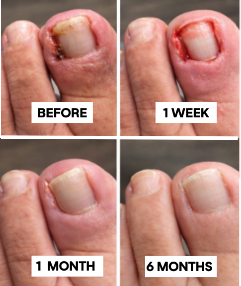 Nail Surgery Before and After