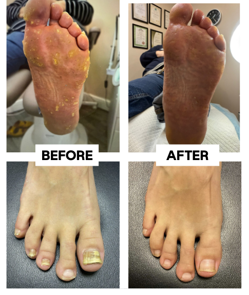 ROUTINE Footcare Before and After