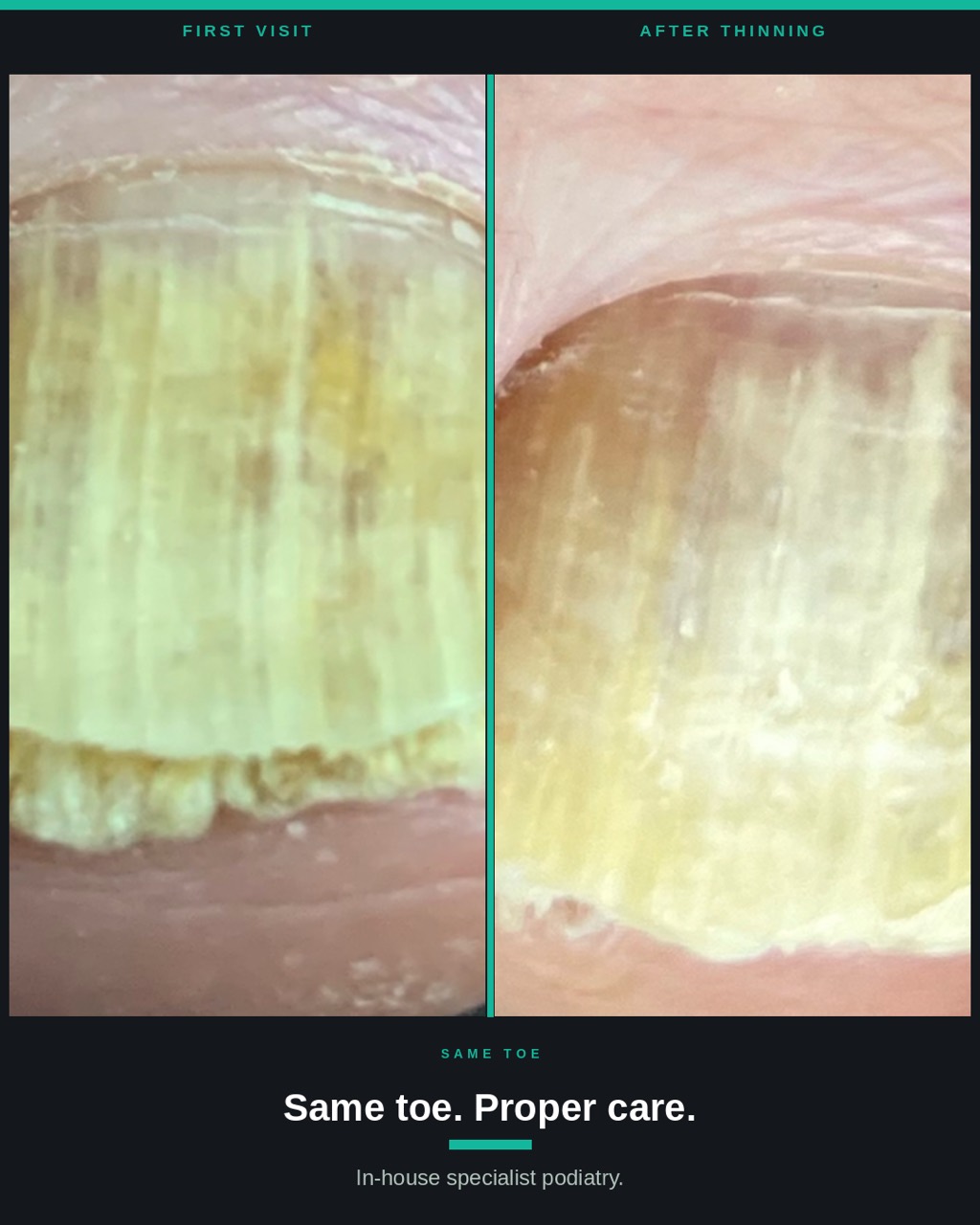 Same toe before and after professional nail thinning