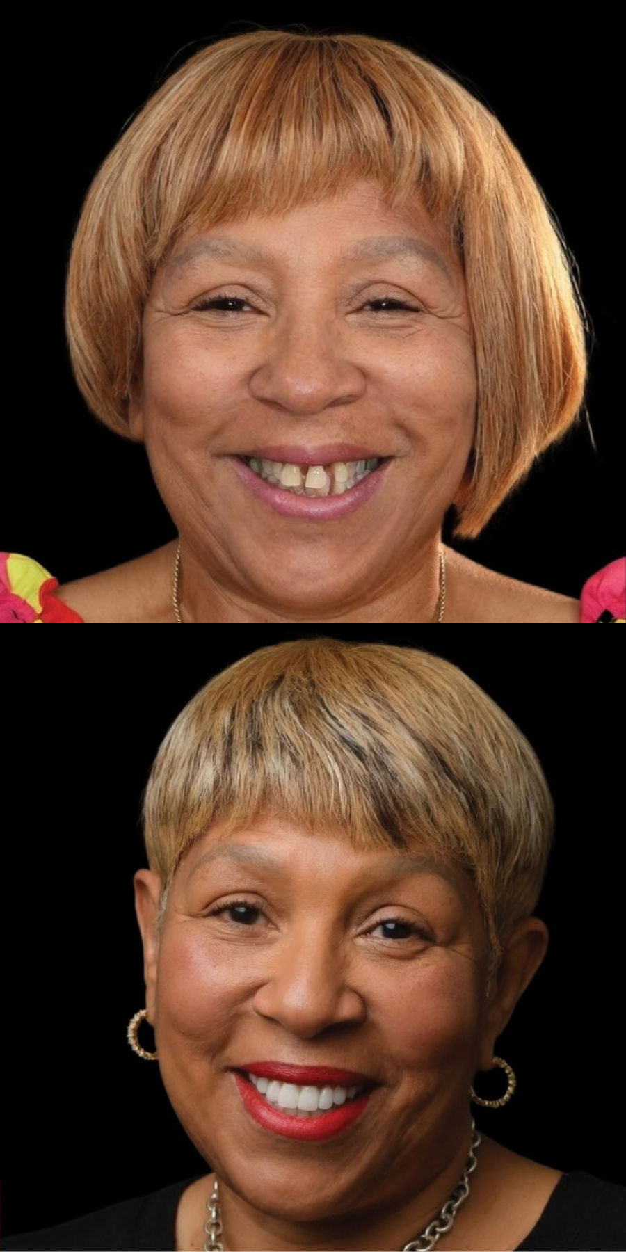 Dental smile transformation 3