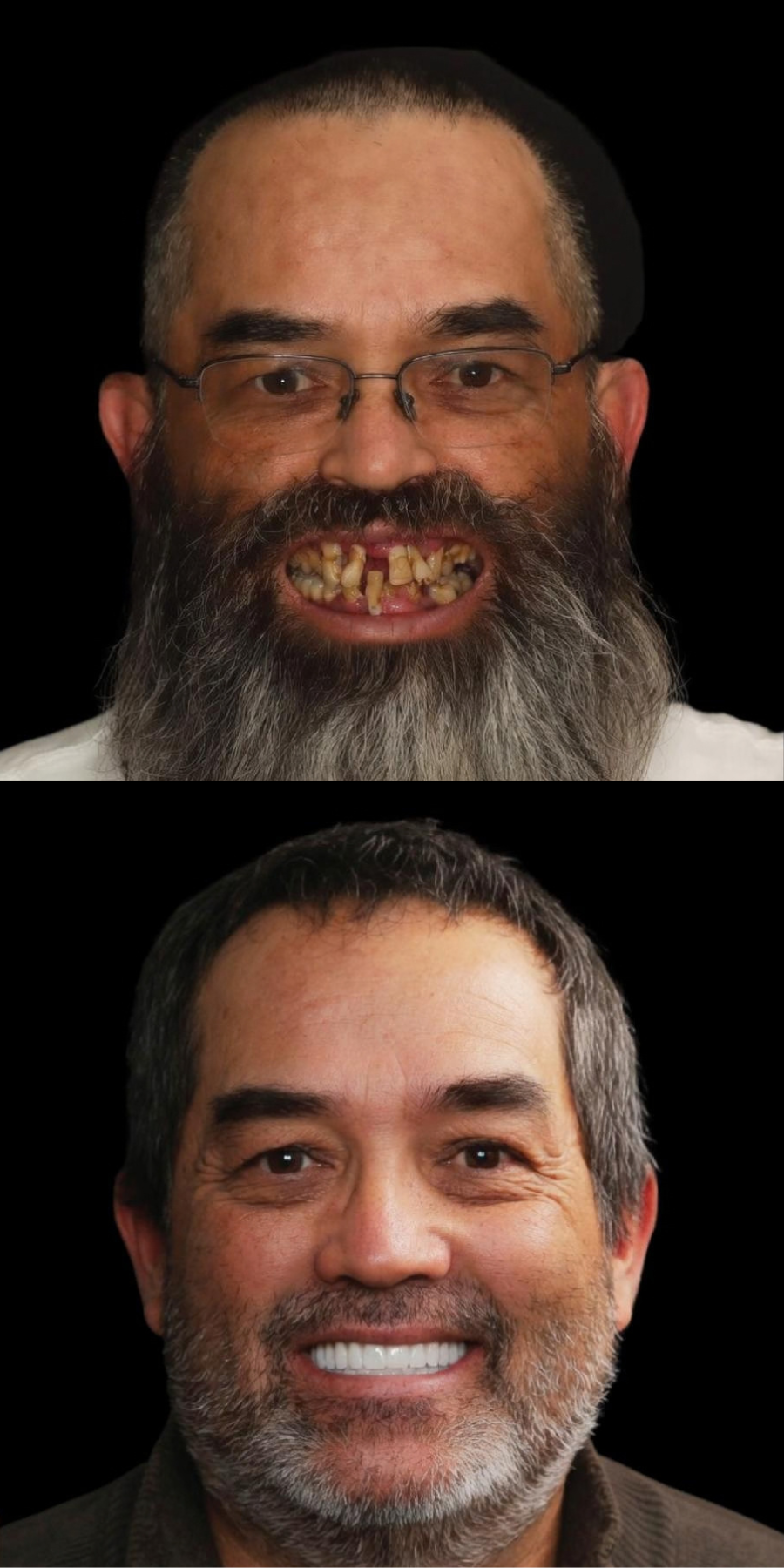 Dental smile transformation 1