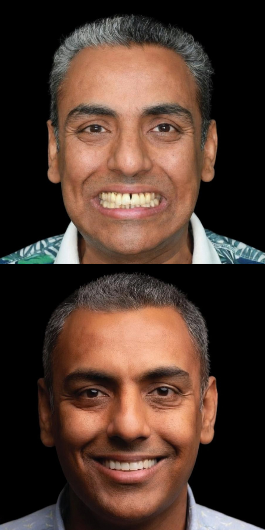 Dental smile transformation 5