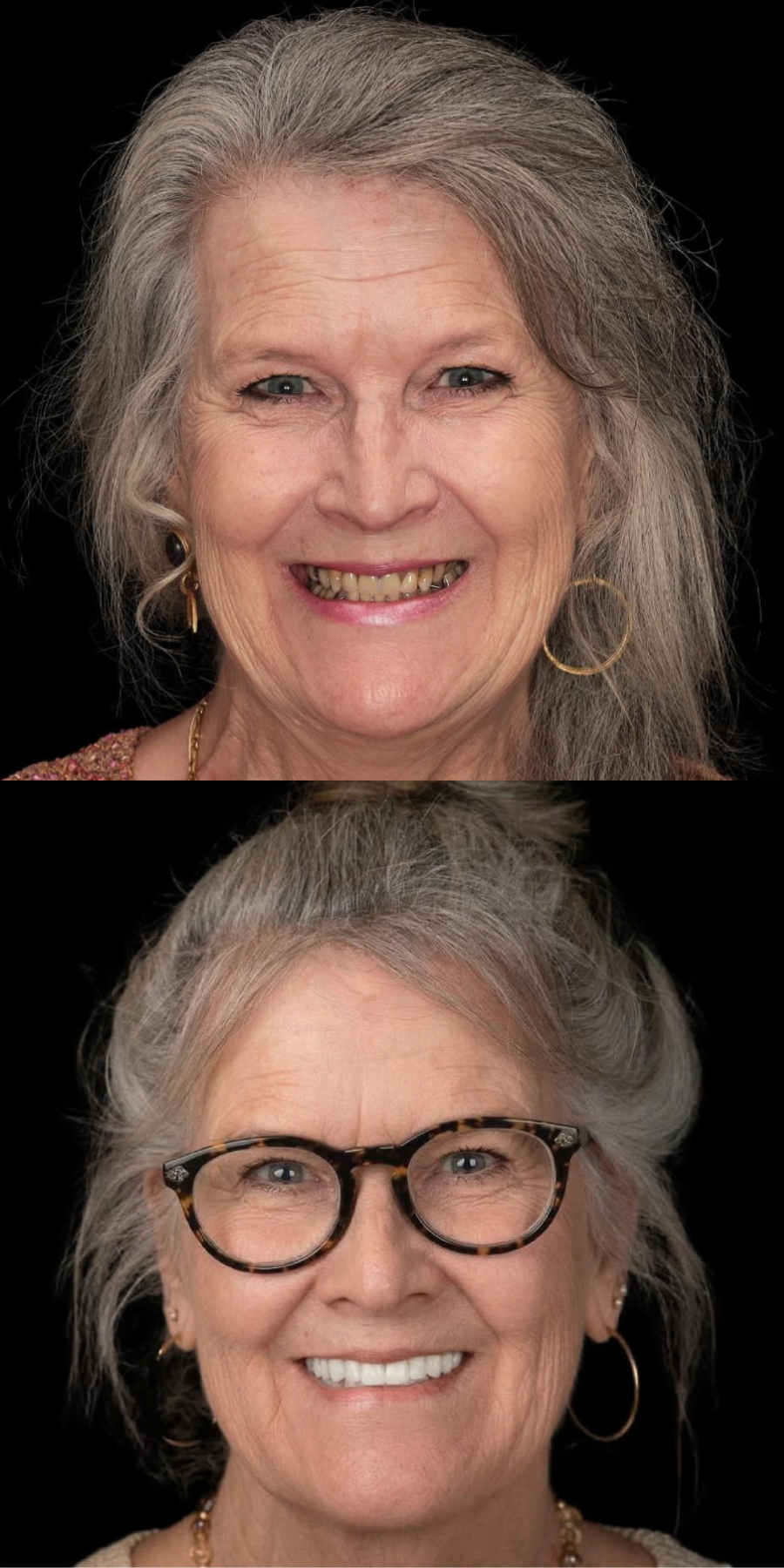Dental smile transformation 2