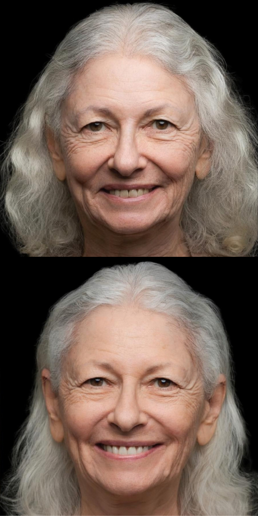 Dental smile transformation 4