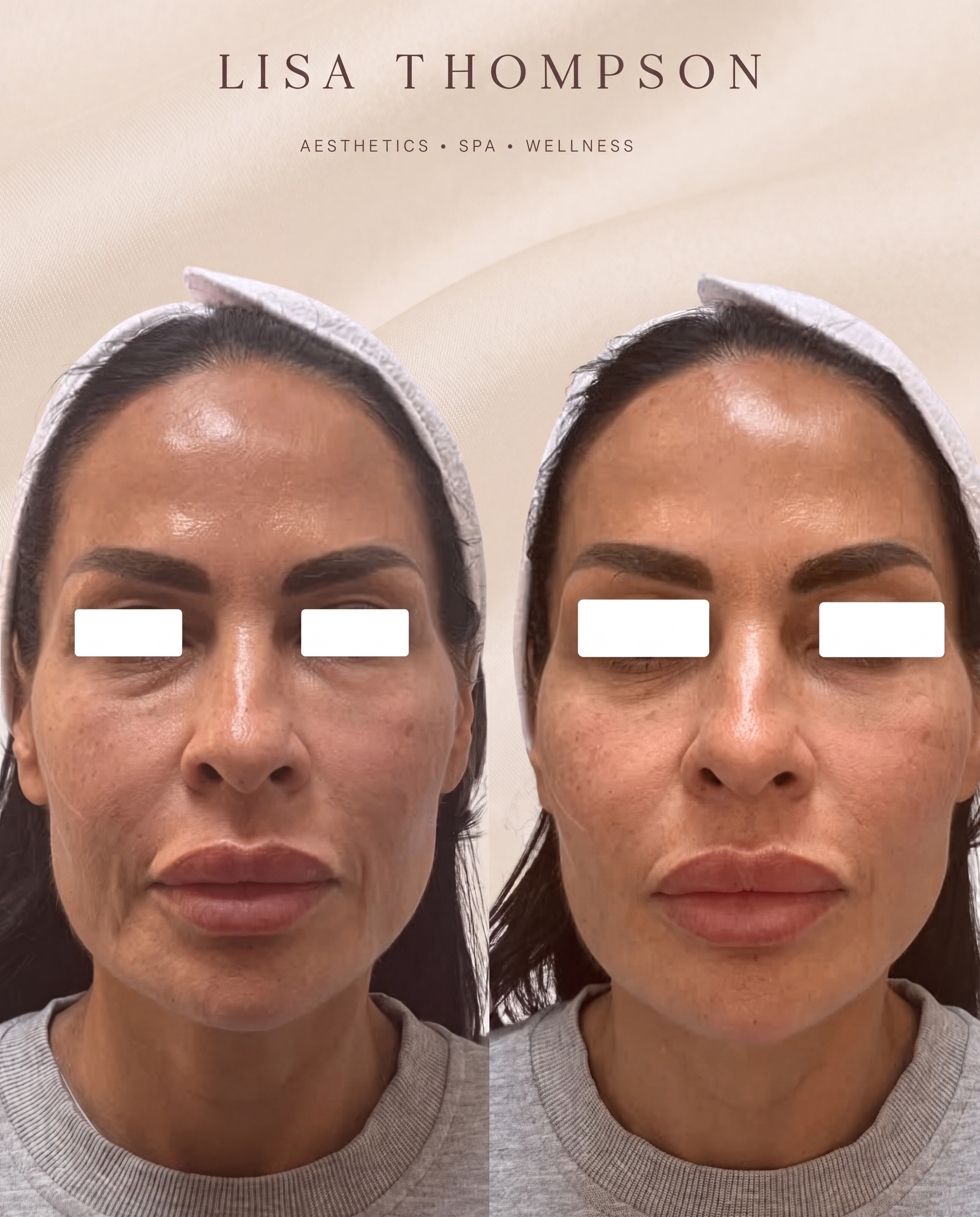 Before and after a PDO thread lift with Lisa Thompson, showing smoother, lifted skin