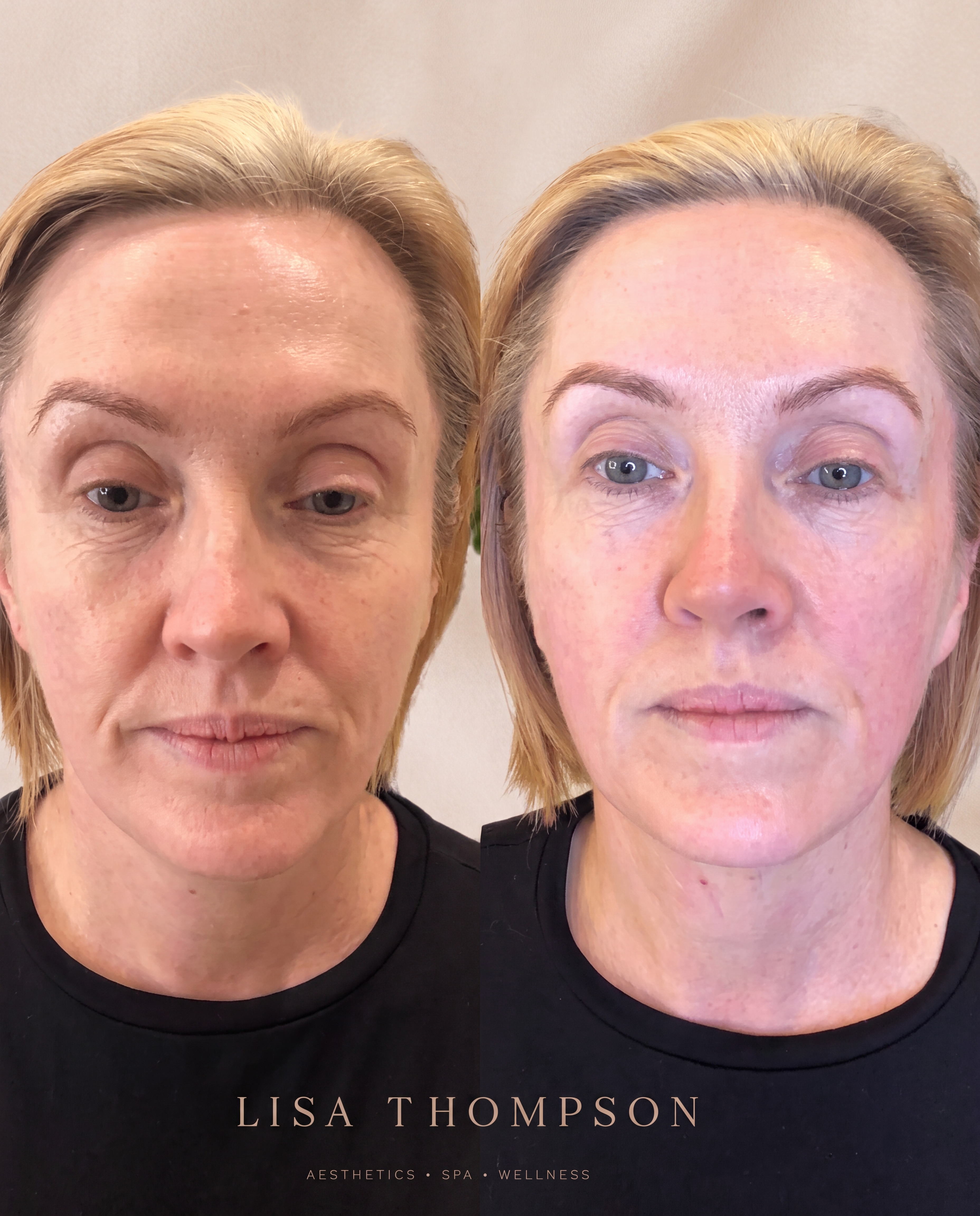 Before and after a PDO thread lift with Lisa Thompson, showing a lifted, natural result