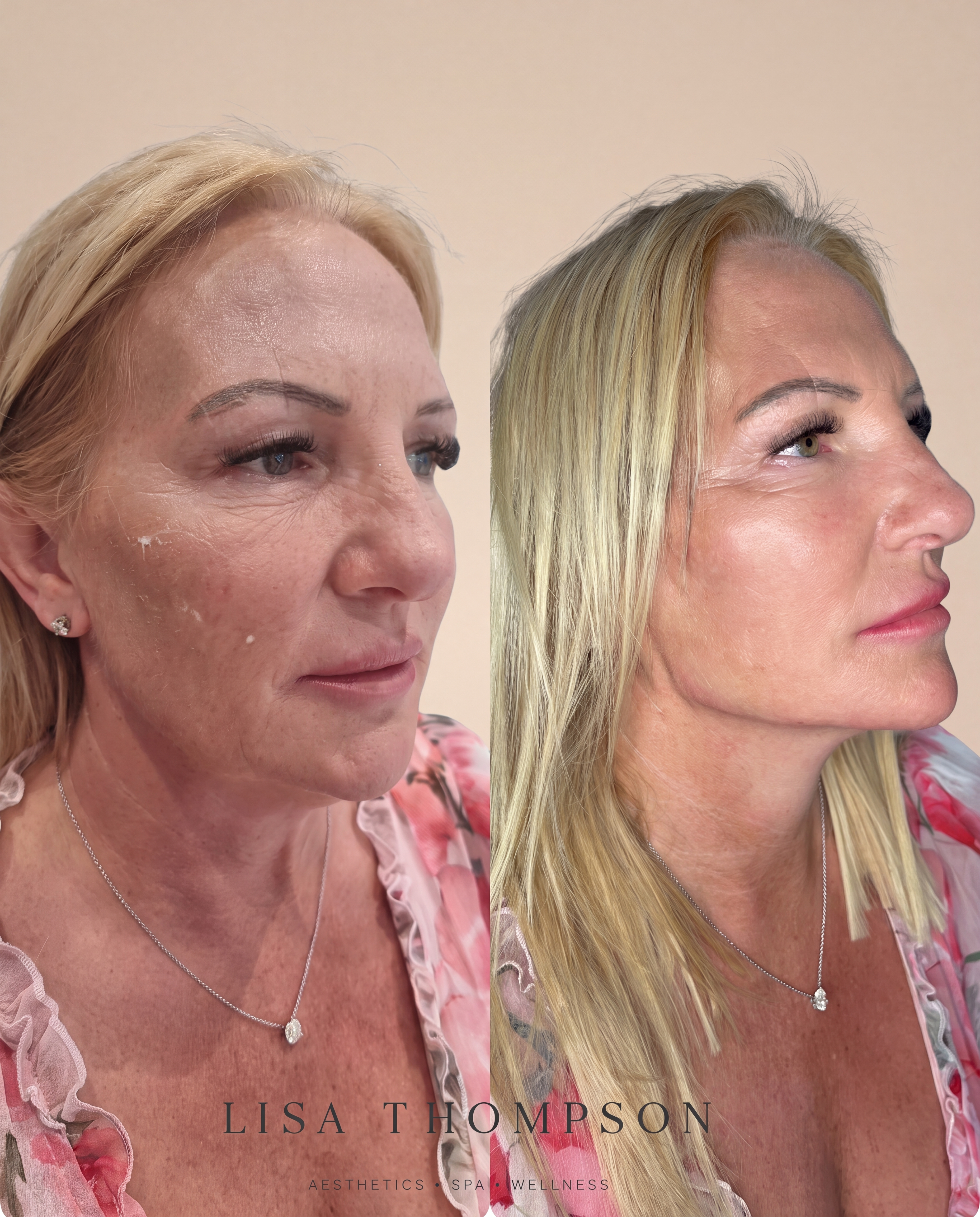 Before and after a PDO thread lift with Lisa Thompson, showing a firmer jawline