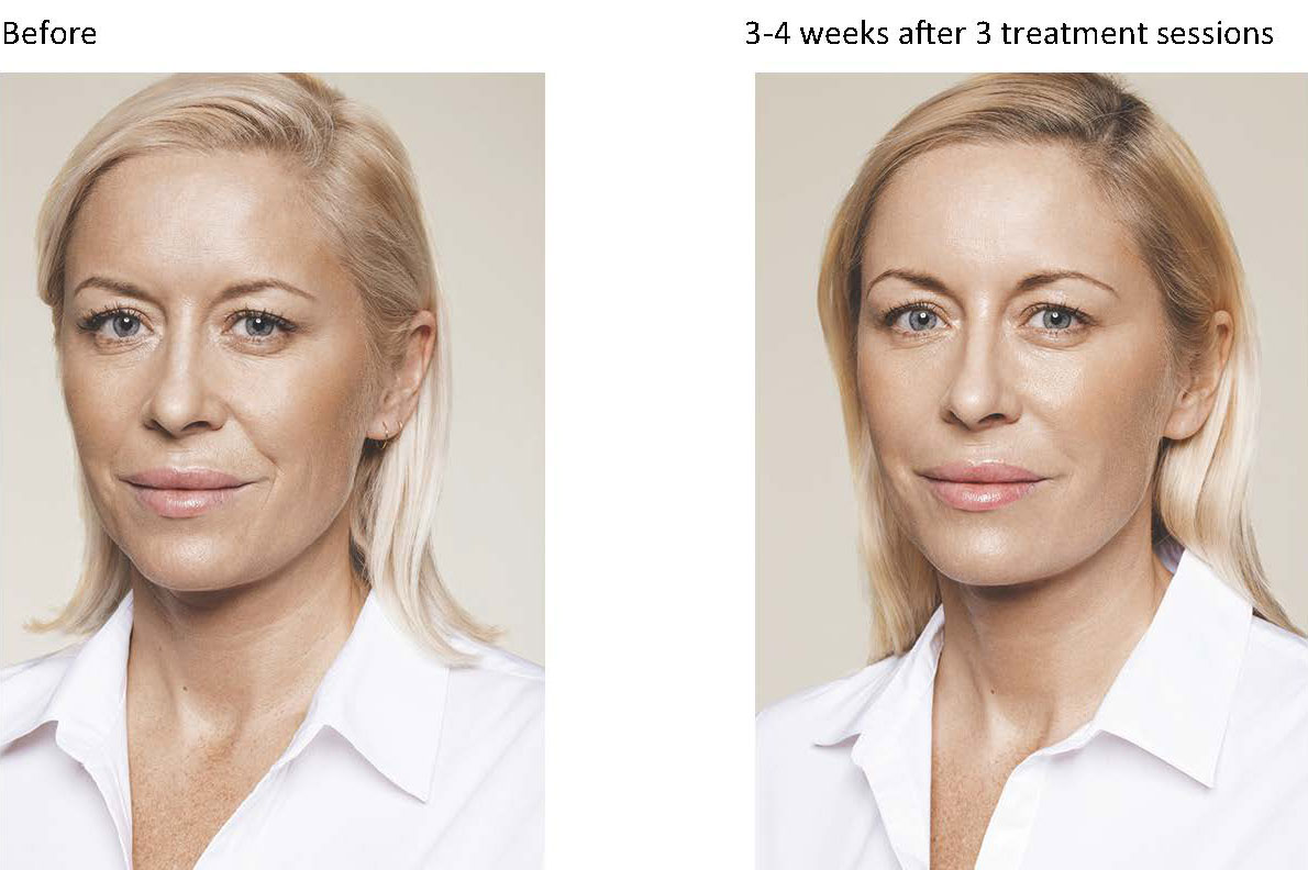 Before and after a course of three skin booster sessions