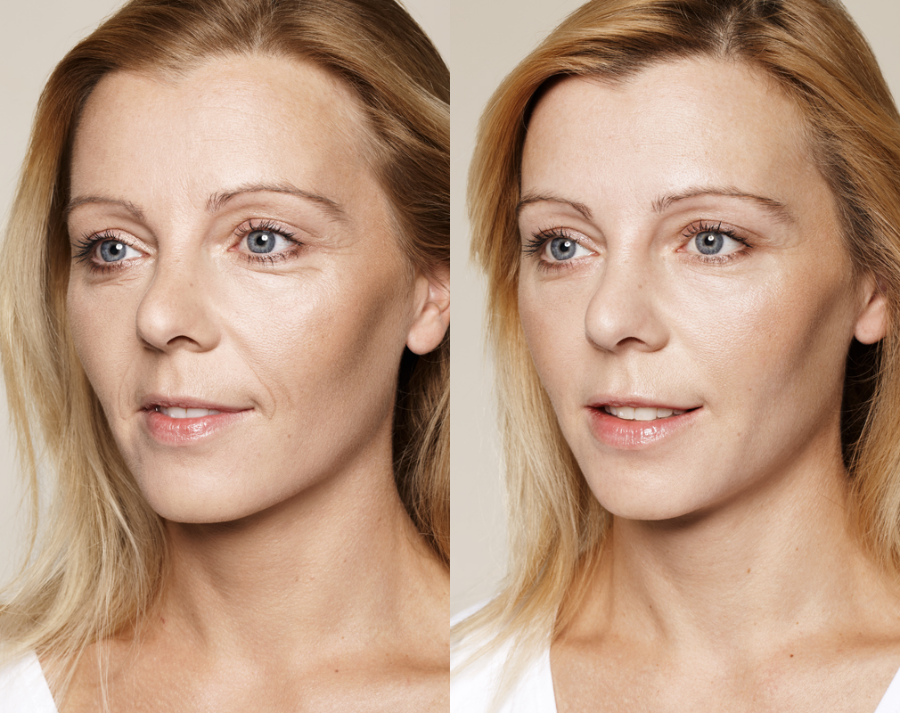 Before and after skin booster treatment
