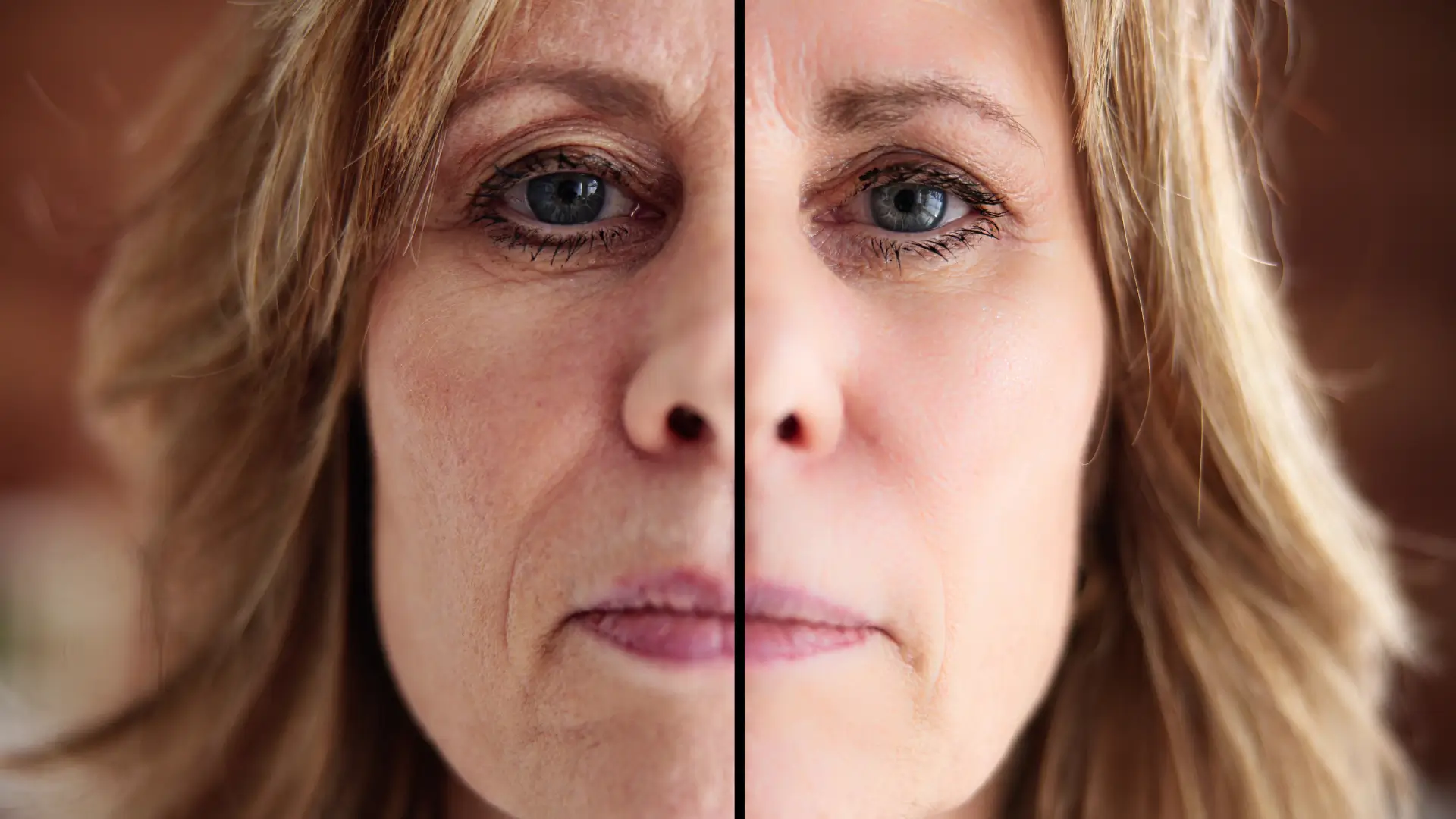 Comparison of skin quality and static lines