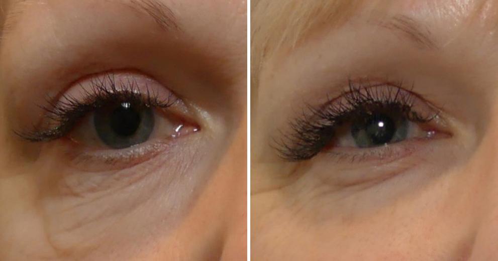 Before and after, Morpheus8 under eye