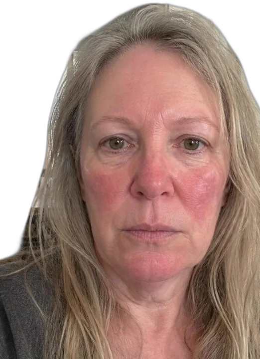 Before treatment, facial redness