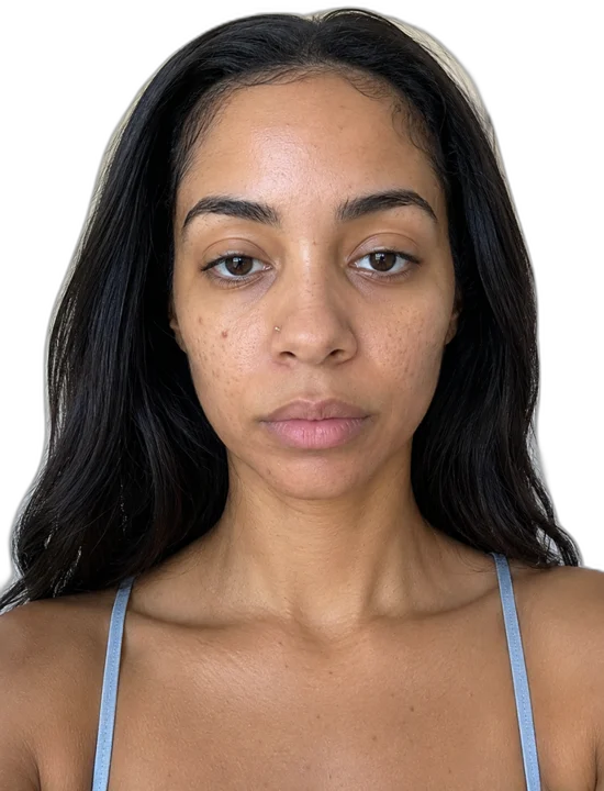 Before treatment, uneven texture and pores