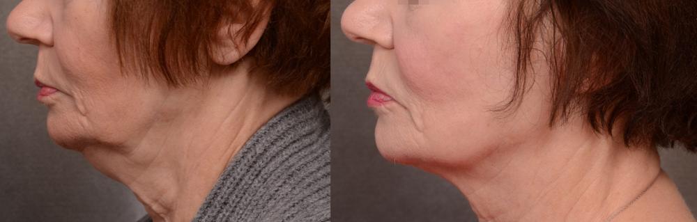 Before and after, Forma lower face and neck