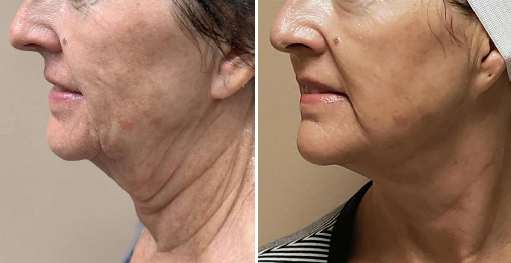 Before and after, Morpheus8 jawline and neck