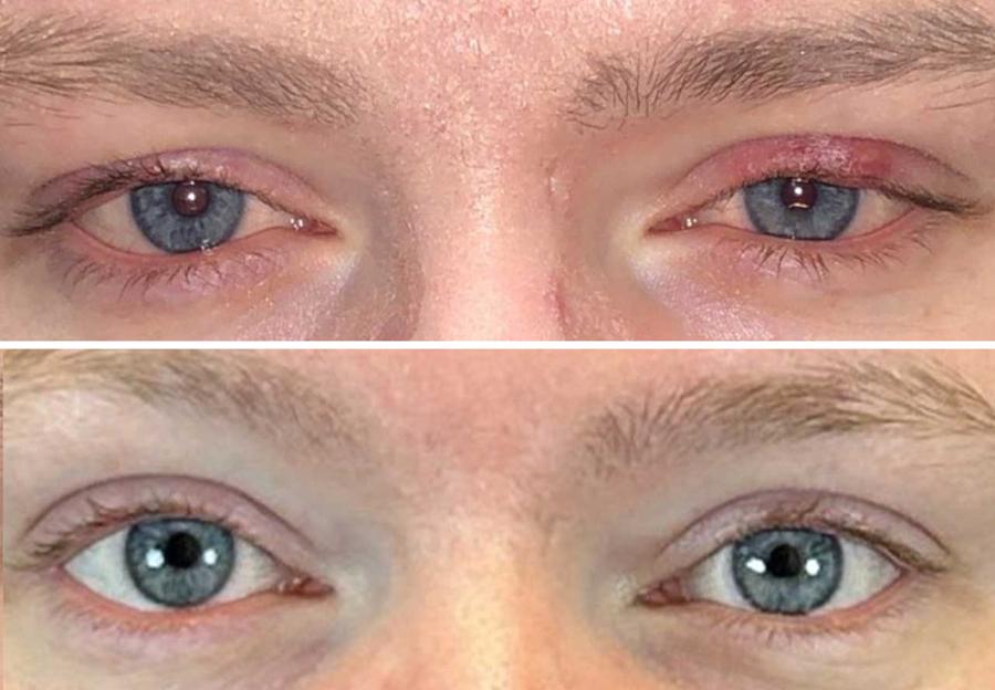 Before and after, Forma-i dry eye