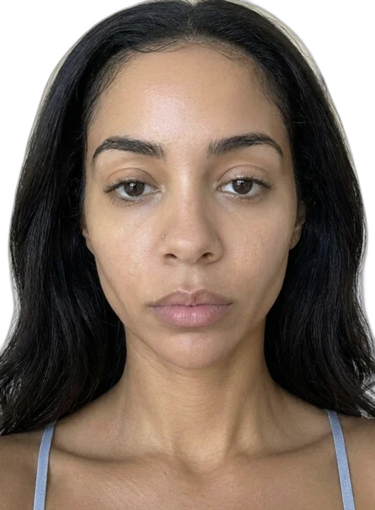 After treatment, smoother, even skin