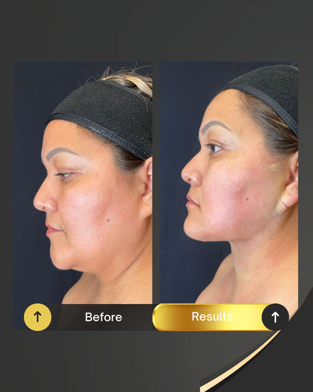 Before double chin removal