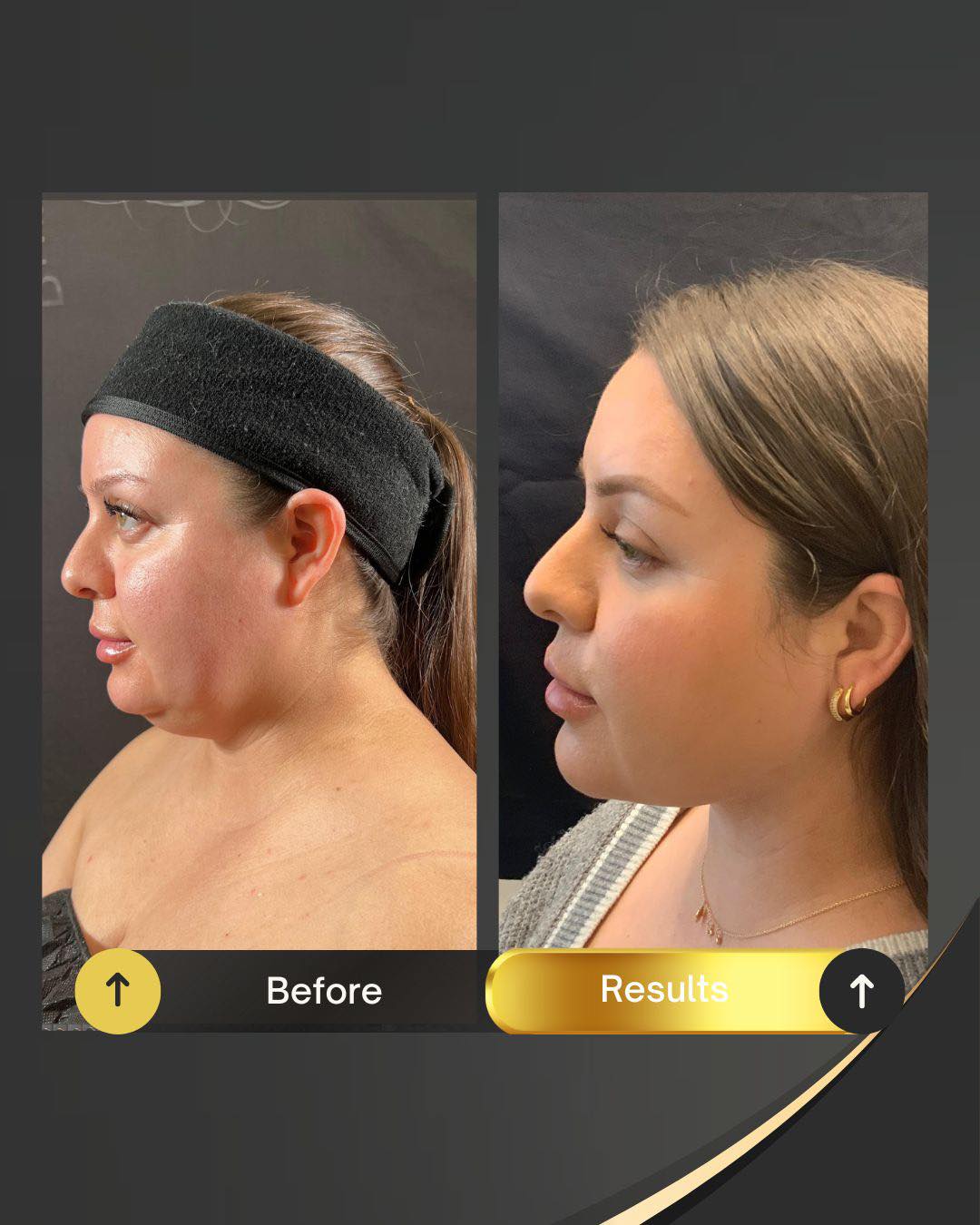 After double chin removal