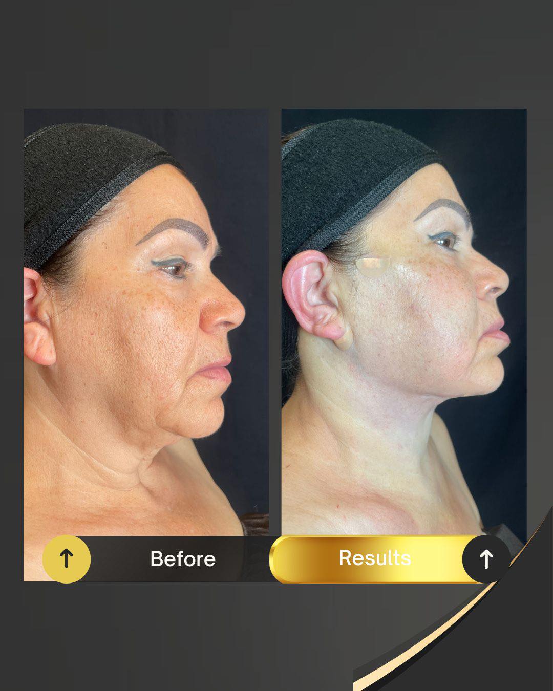 Before jawline contouring